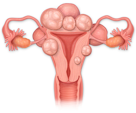 Image of Fibroids & Cysts