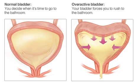 Image of overactive bladder
