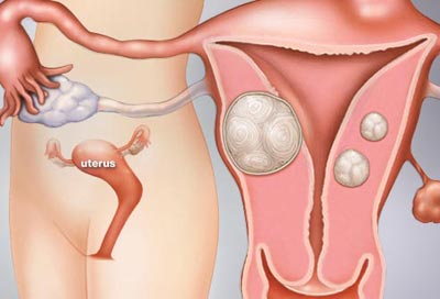 Image of Fibroids & Cysts